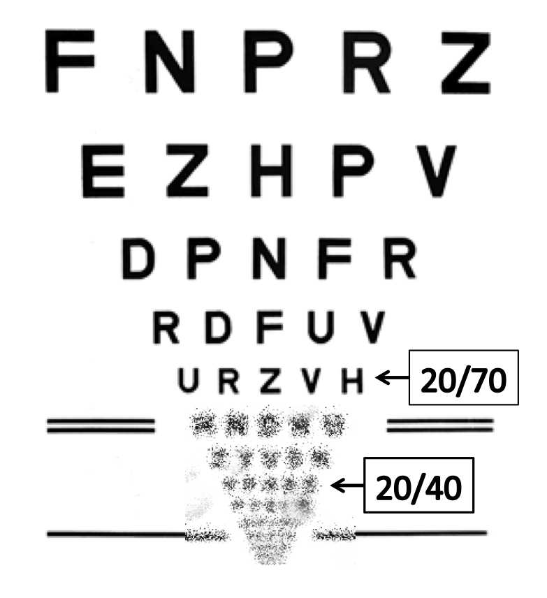 Low Vision Aids